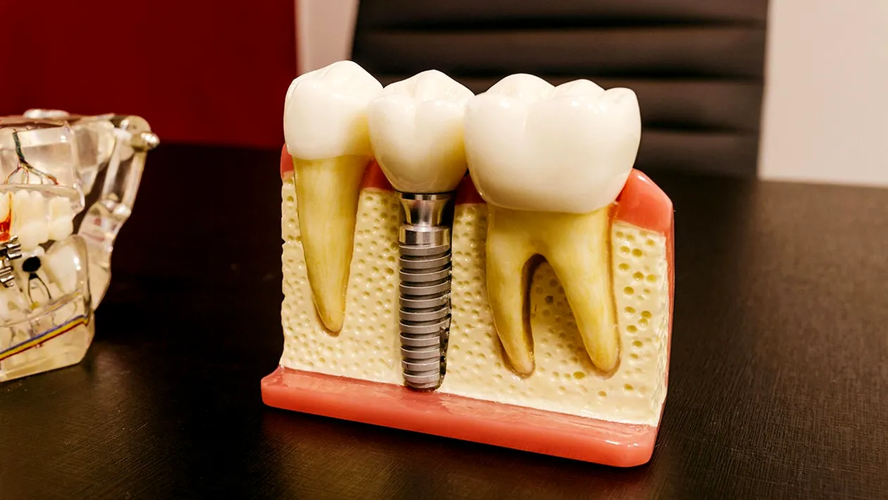 (P) Implanturi dentare rapide - transformare wow în doar 24 de ore!