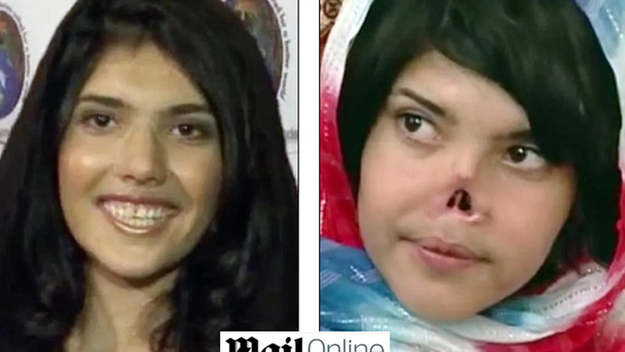 Fata care a sfidat Islamul si a fost mutilata de sotul ei are sansa unei vieti normale! Medicii i-ar refacut chipul