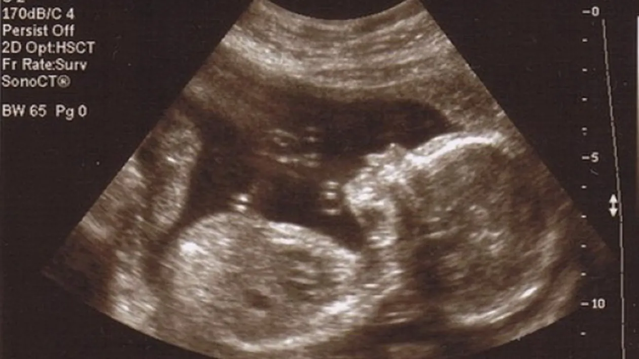 Bebelus nascut fara picioare. Mama spune ca a facut ecografii si i s-a spus ca nu sunt probleme