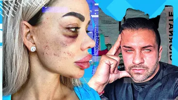 Alex Bodi, declarații stupefiante despre pozele pe care Bianca Drăgușanu și le-a făcut după ce a bătut-o: “Poate să facă 50.000 de plângeri” | VIDEO