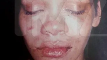 Un rapper celebru si-a DESFIGURAT iubita: M-a batut precum a batut-o Chris Brown pe Rihanna Imagini SOCANTE