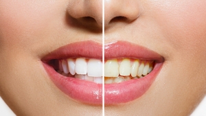 Afla ce trebuie sa faci ca sa iti albesti dintii fara sa te duci la dentist!
