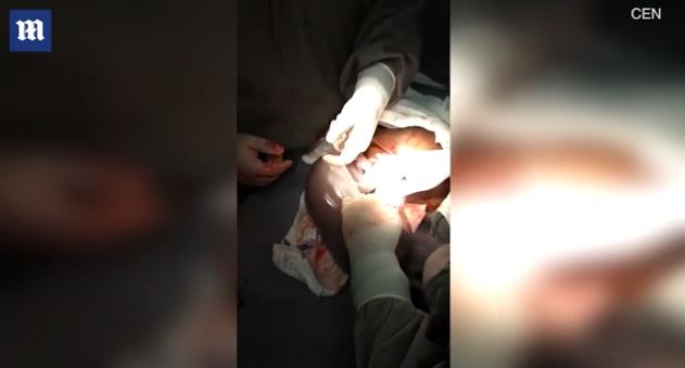 Imagini emoționante în sala de operații: un băiețel s-a născut în timp ce era încă în sacul amniotic. Cazul este foarte rar: 1 la 80.000 de nașteri | FOTO & VIDEO