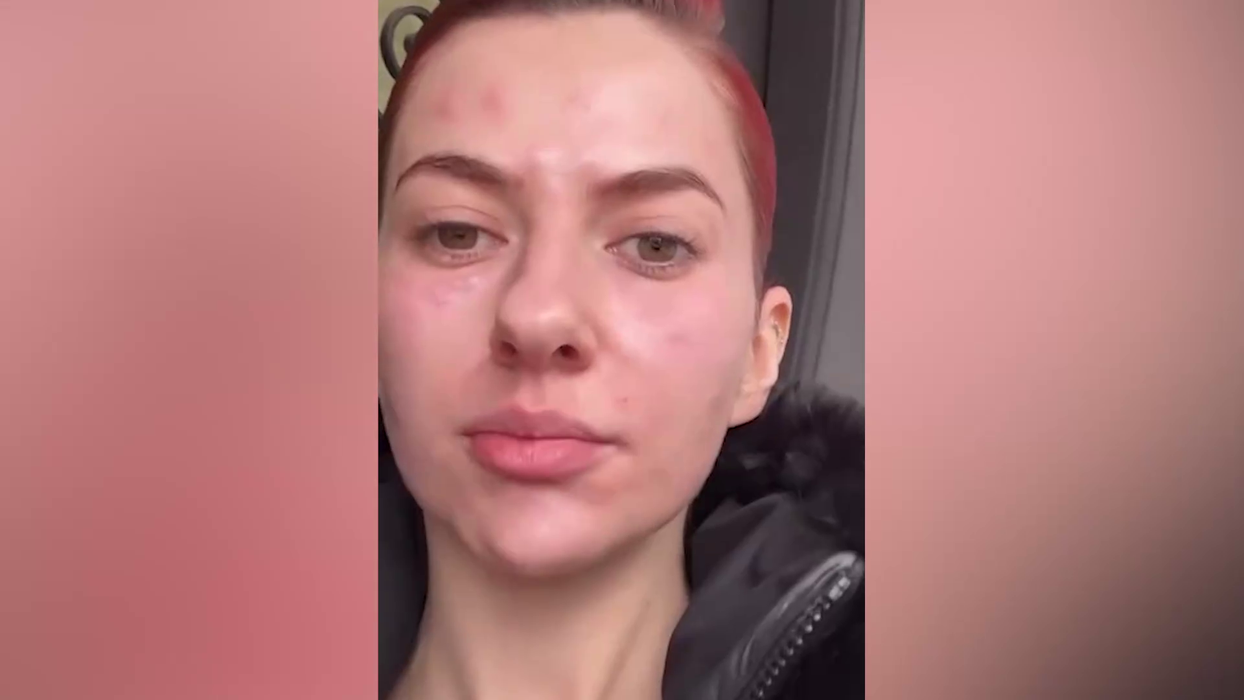 Lidia Buble și-a speriat fanii! A apărut cu fața inflamată și amorțită: „Nu arată rău. Acum e cel mai umflat”