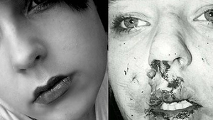 Povestea incredibilă a unei tinere autiste desfigurate de o gaşcă de bătăuşi! Le-a râs în nas şi a devenit model!