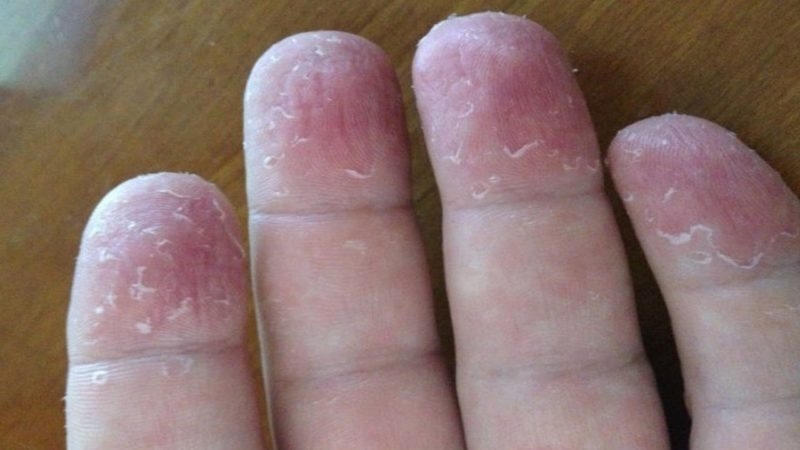 Coronavirusul a suferit mutații. Semnele să văd pe piele. Un nou simptom alertează medicii