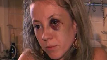 Marian Dragulescu s-a accidentat si are fata tumefiata! Fosta sotie: Acum vede si el cum e sa ai ochii vineti!