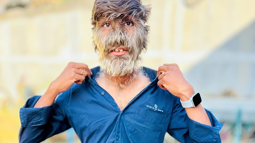 Un adolescent indian este cel mai păros om din lume! Lalit Patidar a intrat în Cartea Recordurilor Guinness