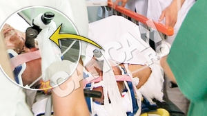 Barbatul ajuns la spital cu o foarfeca infipta in cap este in coma!