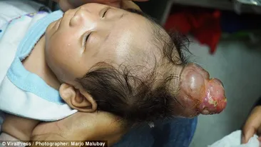 El e copilul unicorn! S-a născut cu un corn deasupra capului! Atenție, imagini care vă pot afecta emoțional