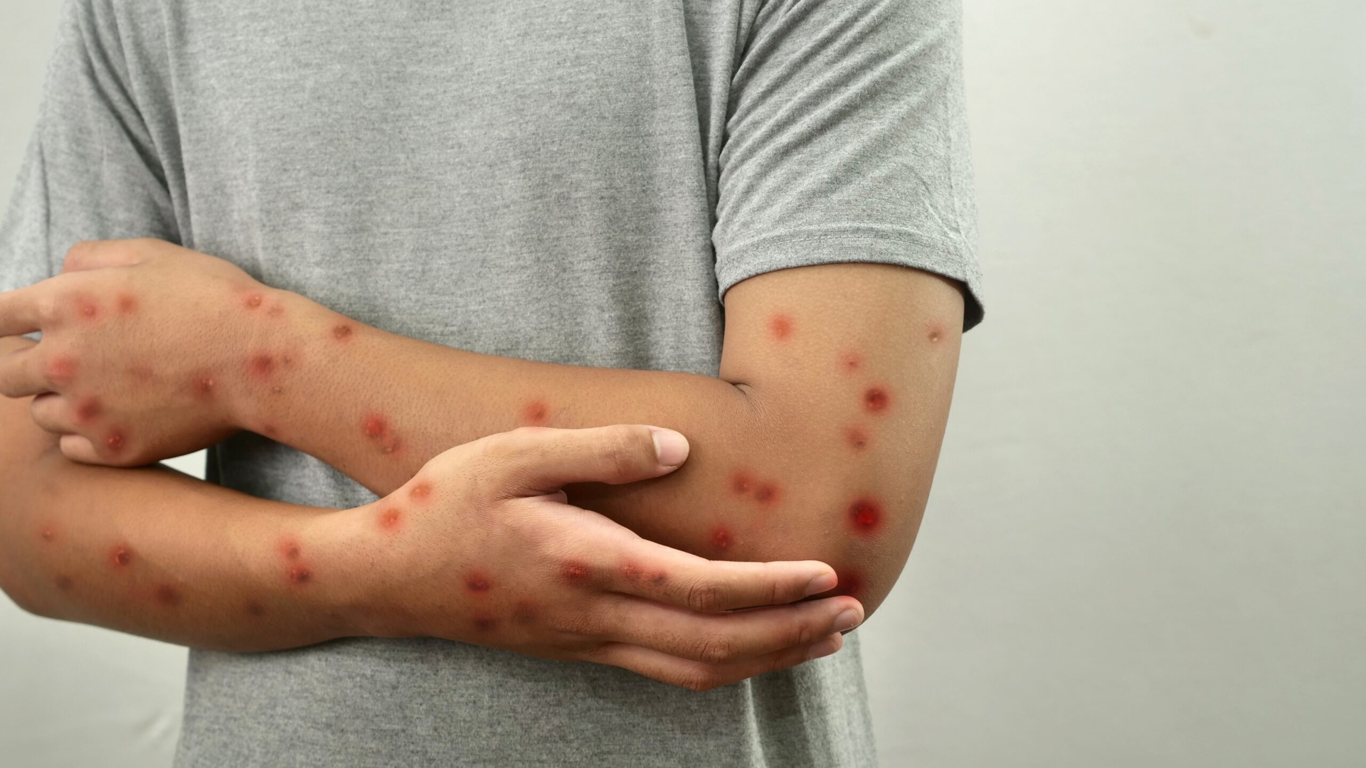 Ce este virusul mpox? A ajuns într-o țară din Europa în care locuiesc o mulțime de români