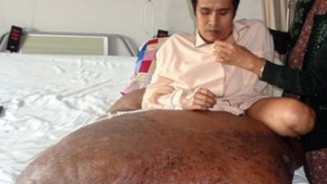 Un vietnamez este operat pentru a scapa de o tumora ce cantareste 90 de kilograme