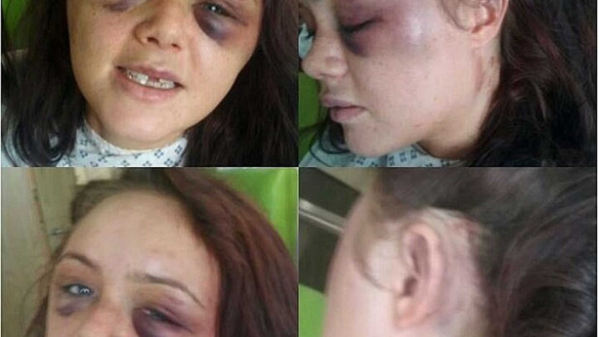IMAGINI ŞOCANTE! O tânără a fost snopită în bătaie de iubitul ei, luptător de arte marţiale! Care a fost motivul acestuia
