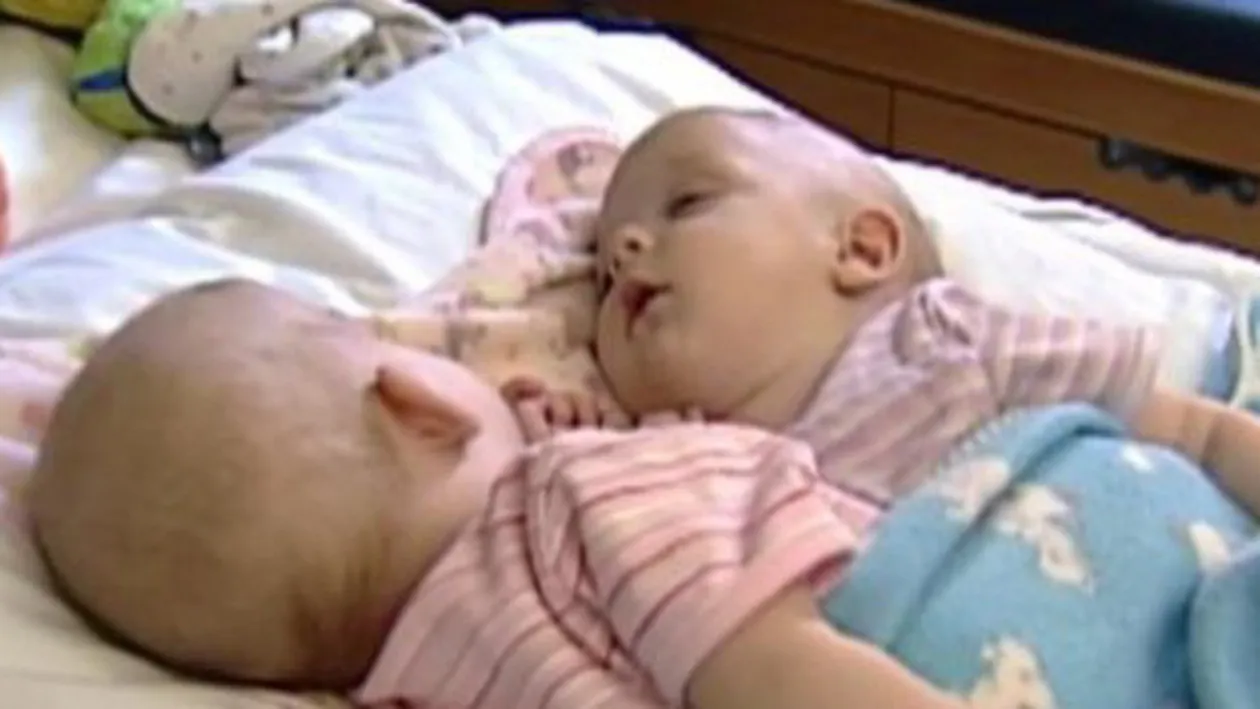 Acum 10 ani, doctorii au încercat să separe cele două siameze! Cum arată fetiţele acum 