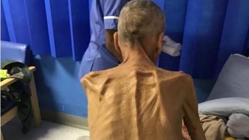 A murit bărbatul care cântărea 38 de kg, trimis de stat la muncă!