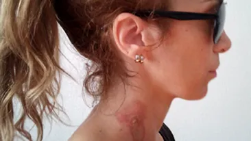 Annes a fost arsa pe gat cu ondulatorul de catre hair stylista! Cantareata se trateaza acum cu sange de vitel!