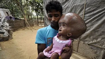 Imaginile cu ea au facut inconjurul lumii! ASA arata aceasta fetita inainte de operatie! Cum s-a transformat