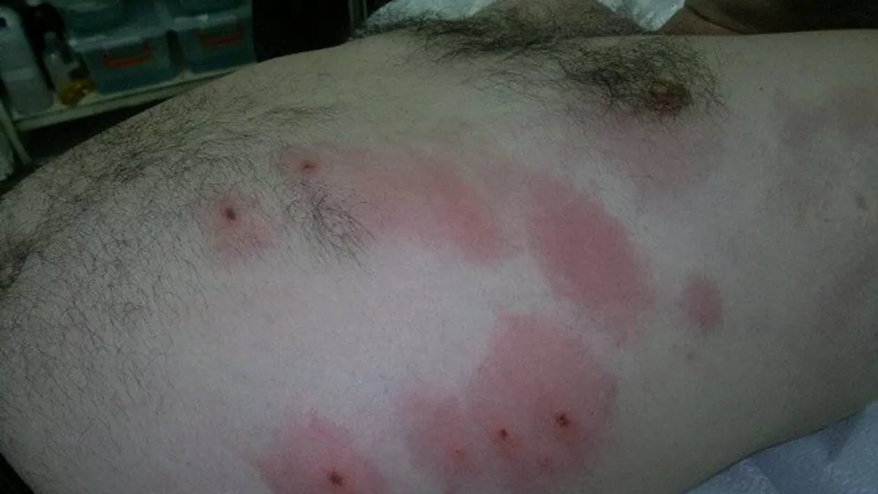 INVAZIA CAPUSELOR! Un iesean a fost muscat de 12 capuse in cateva minute in timp ce se relaxa in iarba