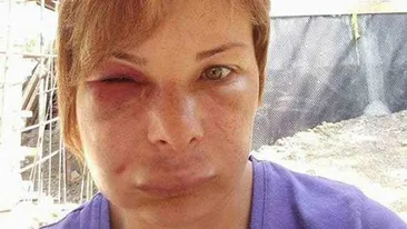 Atenţie, imagini cu un puternic impact emotional! A desfigurat-o stomatologul! I-a scos 4 măsele, iar rezultatul este TERIFIANT