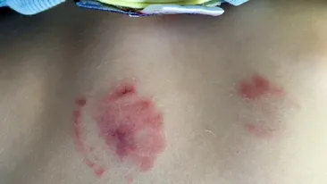 Un copil a venit de la grădiniţă cu MUŞCĂTURI pe tot corpul. Explicaţia HALUCINANTĂ a directoarei pentru părinţi: Înţeleg îngrijorarea dumneavoastră, dar, în acelaşi timp...