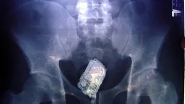Un detinut si-a ascuns telefonul mobil in anus la Penitenciarul de la Poarta Alba! A refuzat sa fie operat si asteapta sa il elimine pe cale naturala