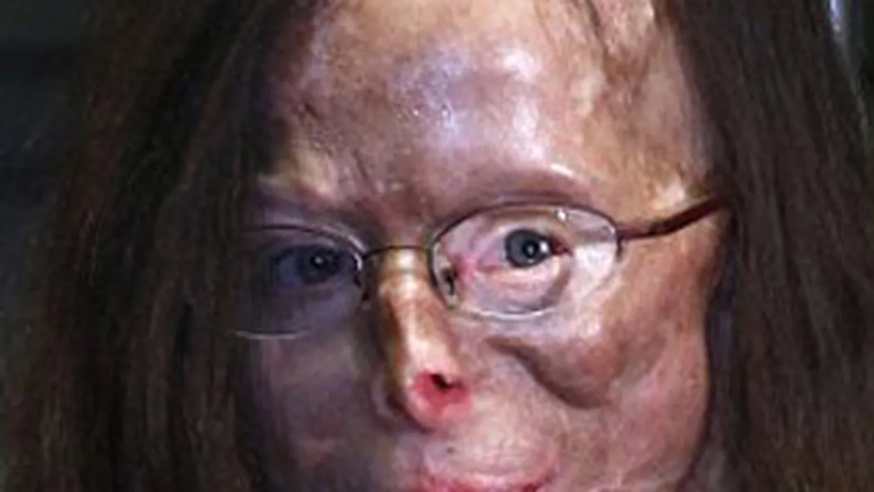 IMAGINI INGROZITOARE! Nasul i se dezintegreaza, nu mai aude si i s-a amputat un deget! Femeia asta a ajuns un cadavru, dupa ce a fost desfigurata cu vitriol de fostul amant!