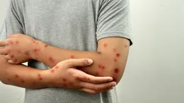 Ce este virusul mpox? A ajuns într-o țară din Europa în care locuiesc o mulțime de români