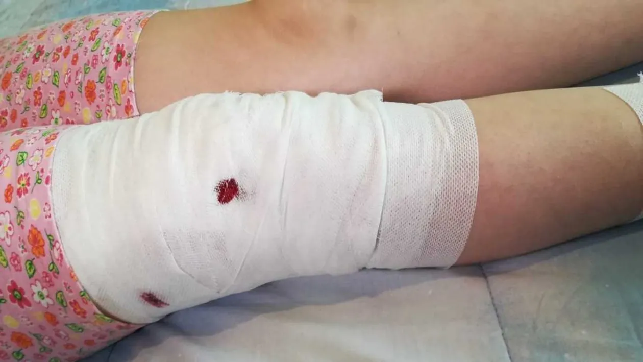 Fetiță de 10 ani din Mediaş, atacată de un câine maidanez. Copilul a fost mușcat de nas, mâini și picioare | VIDEO