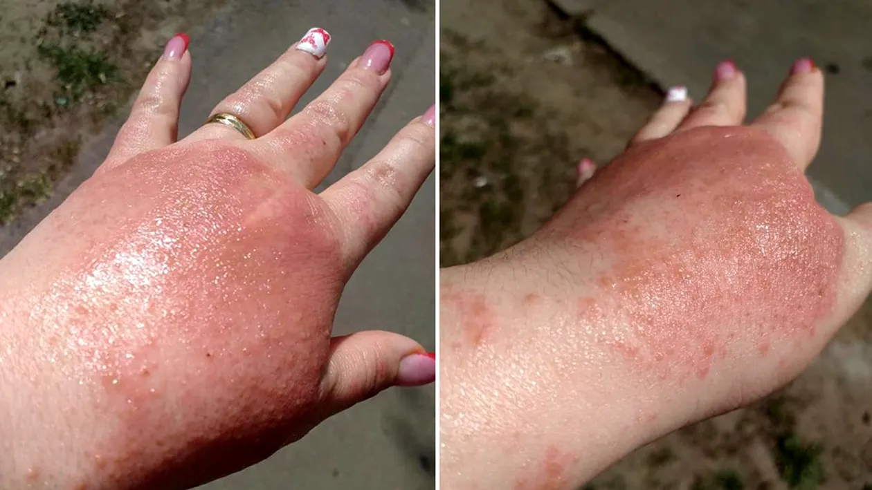 Imagini ireale! Ce a pățit o femeie după ce s-a spălat cu dezinfectant într-un supermarket din Brăila