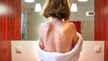 Rujeola face prăpăd. Aproape 160 de copii au murit. Peste 2.000 de cazuri de infectare