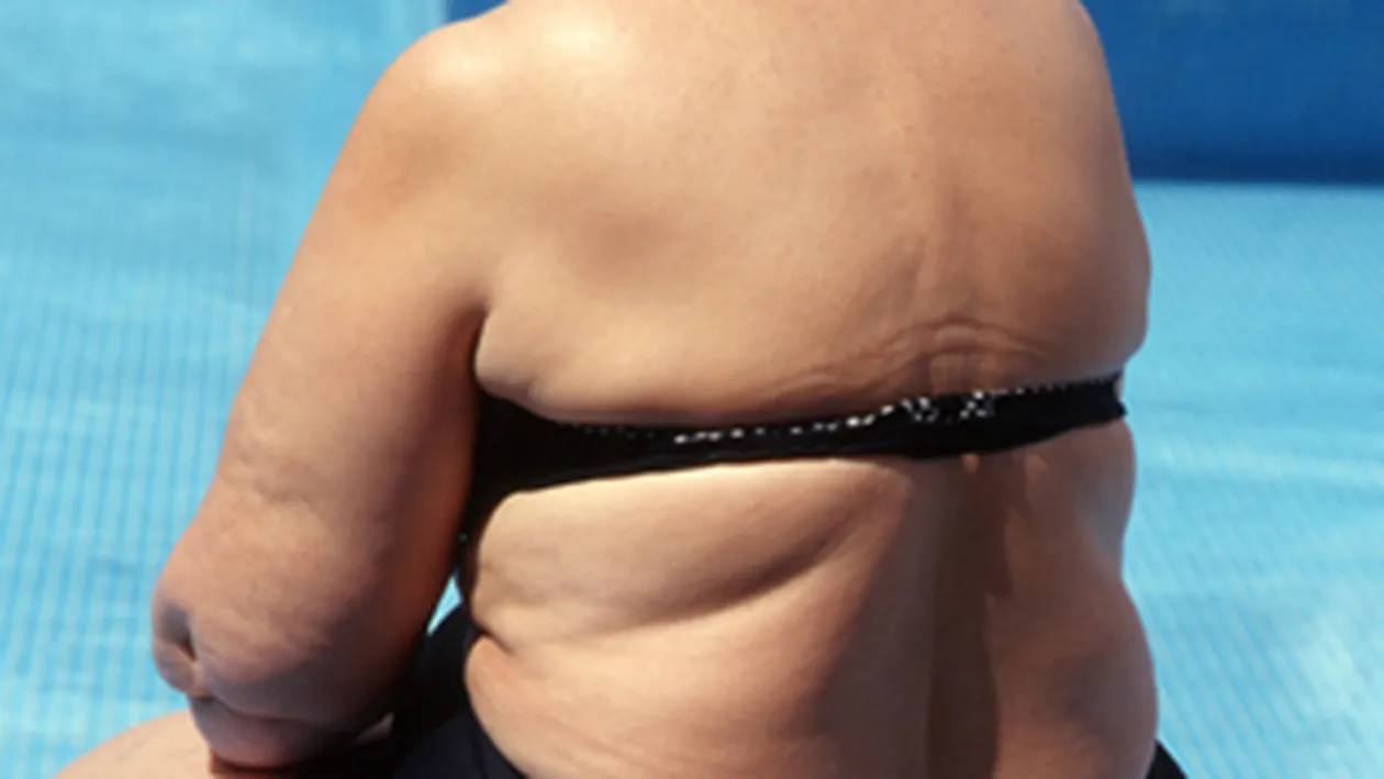 Obezitatea duce la prostie