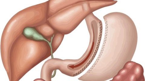 Vedete care şi-au micşorat stomacul. Viaţa li s-a schimbat total după operaţie