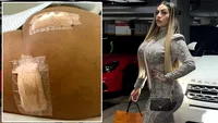 Ce a pățit tânăra din imagine, după ce și-a făcut o operație de remodelare a posteriorului, pe care a dat 9.230 de euro. Când s-a uitat în oglindă, să cadă din picioare