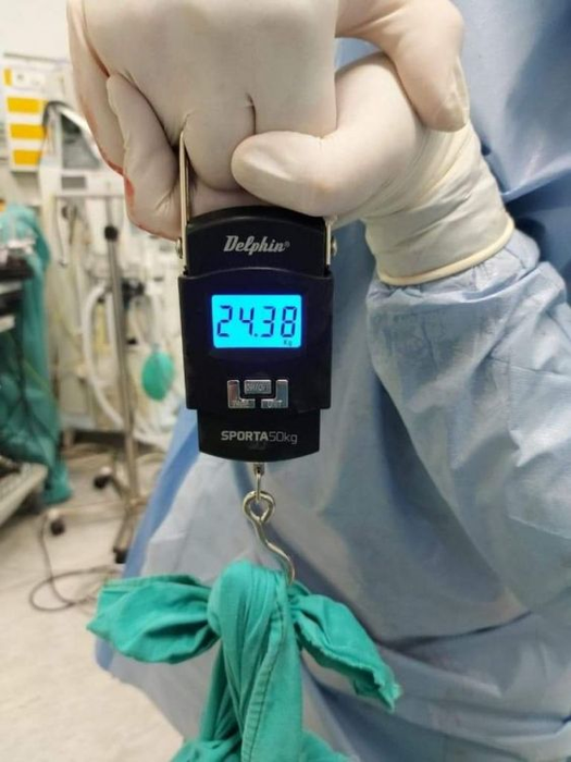 FOTO. Caz incredibil la Botoșani. Tumoare de 24 de kilograme, extirpată din abdomenul unei femei infectată cu COVID-19