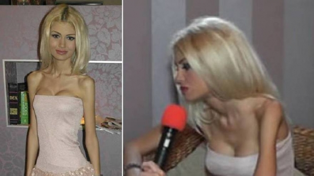 În 2013, anorexica Flavia Apostol avea doar 38 kg la 1.72 m! Cum arată acum și câte kilograme are