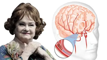 Care sunt simptomele bolii care a ucis-o pe Stela Popescu! Aceştia sunt paşii prin care le poţi recunoaşte. Află cum să te fereşti de un atac cerebral