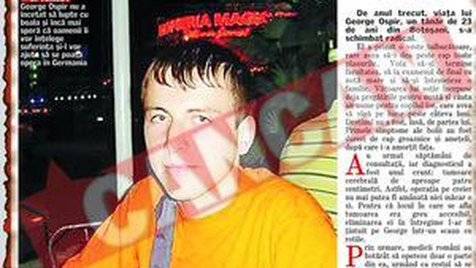 Operat pe creier cu ajutorul CANCAN
