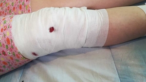 Fetiță de 10 ani din Mediaş, atacată de un câine maidanez. Copilul a fost mușcat de nas, mâini și picioare | VIDEO
