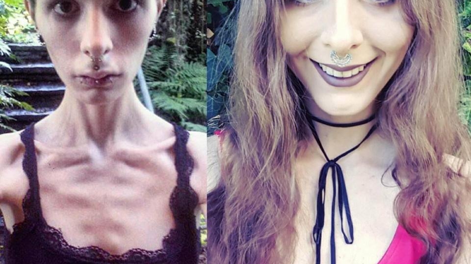 Cazul şocant al fetei care îşi ascundea mâncarea în urechi! Julia cântărea 32 de kilograme, dar a învins anorexia. Cum a reuşit!