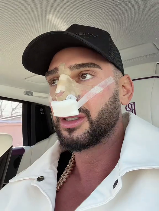 Dorian Popa și-a dat bandajele de la nas jos: „Am plâns ca un bebeluș.” Care este motivul?