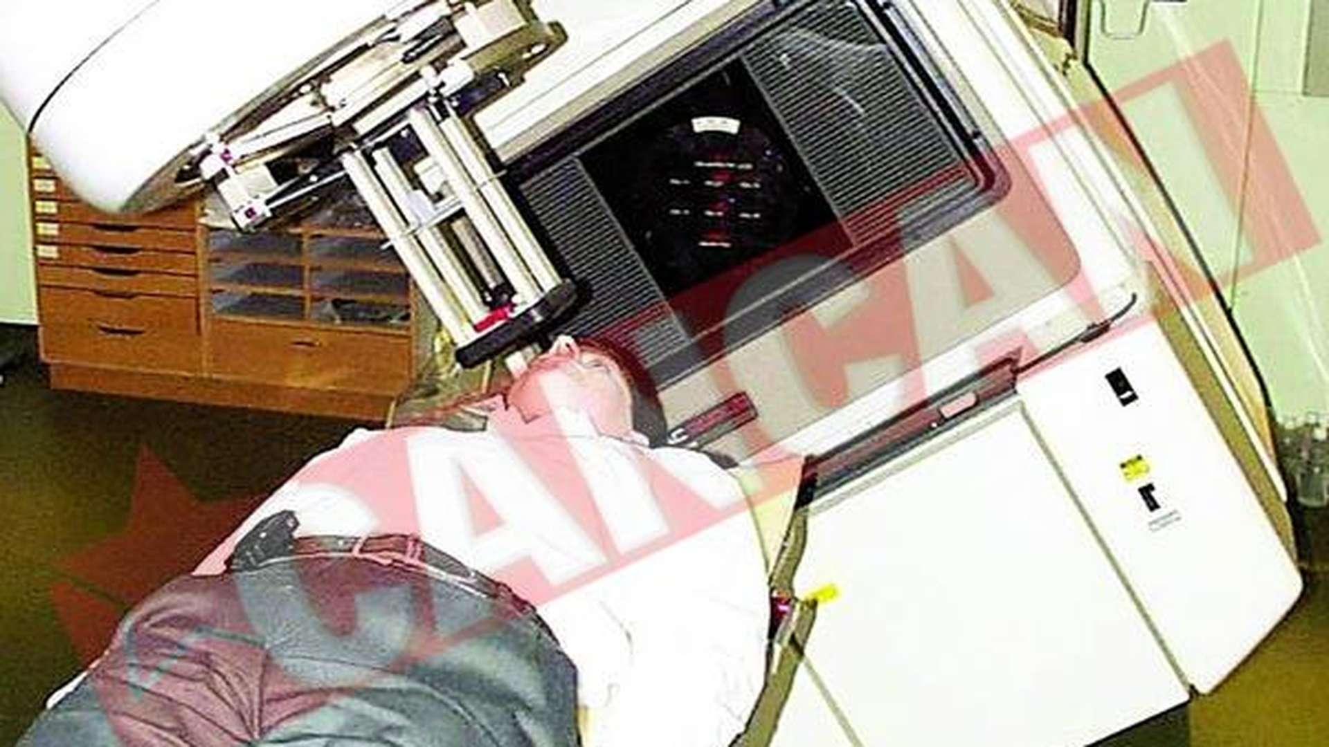 Efectele secundare ale radioterapiei