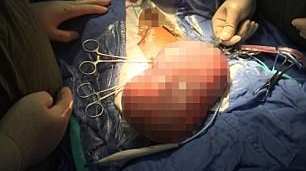 Un copil de opt ani a fost operat de urgenţă, după ce "burta lui era pe punctul de a exploda" pentru că nu putea merge la toaletă! Doctorii i-au scos 3 kg de excremente de mărimea unei mingi de baschet