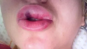 Cele mai socante buze de vedeta! Sunt imense si pline de vanatai! Cine crezi ca a facut greseala asta? Am exagerat putin