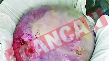 I-au scos o tumora de 15 kilograme din ovar