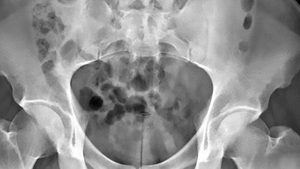Halucinant! Medicii i-au scos din penis o jucărie sexuală de 20 cm, după ce dispozitivul i s-a blocat în vezică