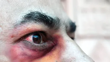 Alertă! „Ciuperca neagră”, care lasă bolnavii de COVID-19 fără ochi, a început să se răspândească în lume