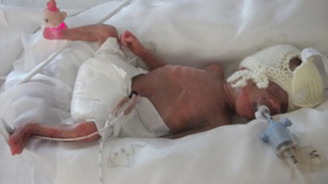 VEZI AICI cum arata doi frati gemeni care s-au nascut la 5 luni si sunt perfect sanatosi