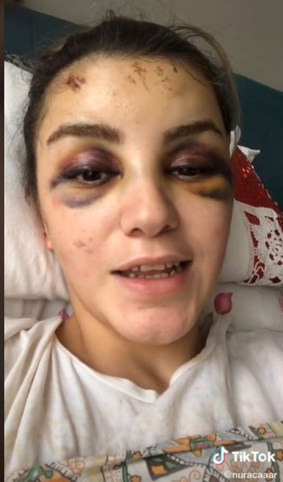 Nurella, victima unui accident bizar