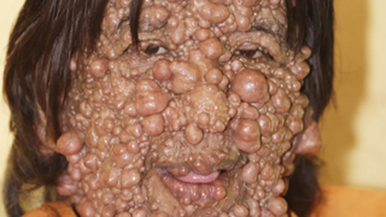 IMAGINI NERECOMANDATE PERSOANELOR SENSIBILE! Are fata si corpul pline de basici! Uite cum arata un indonezian afectat de sute de tumori!