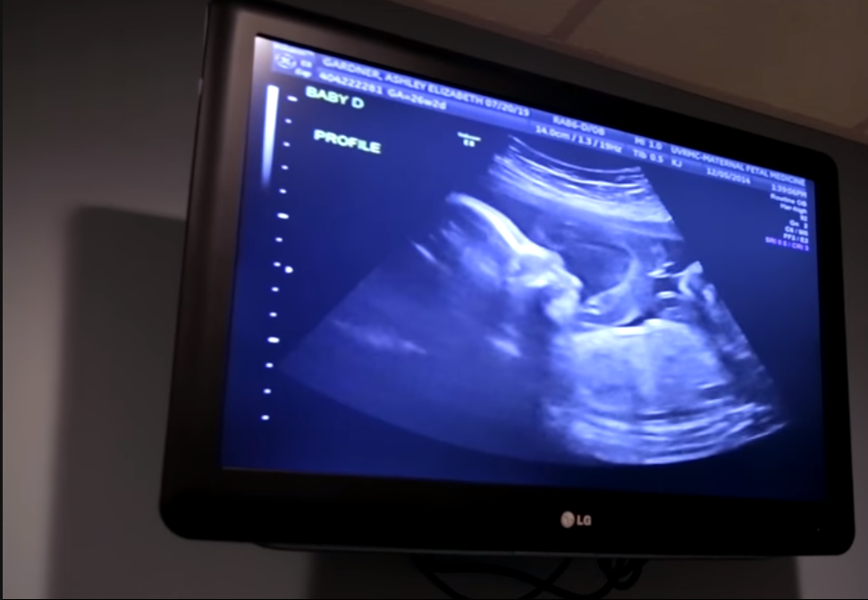 Incredibil! O femeie a rămas însărcinată cu doua perechi de gemeni identici, patru fetite